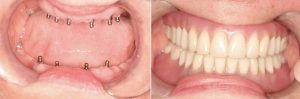 denture implants, pictures of implant