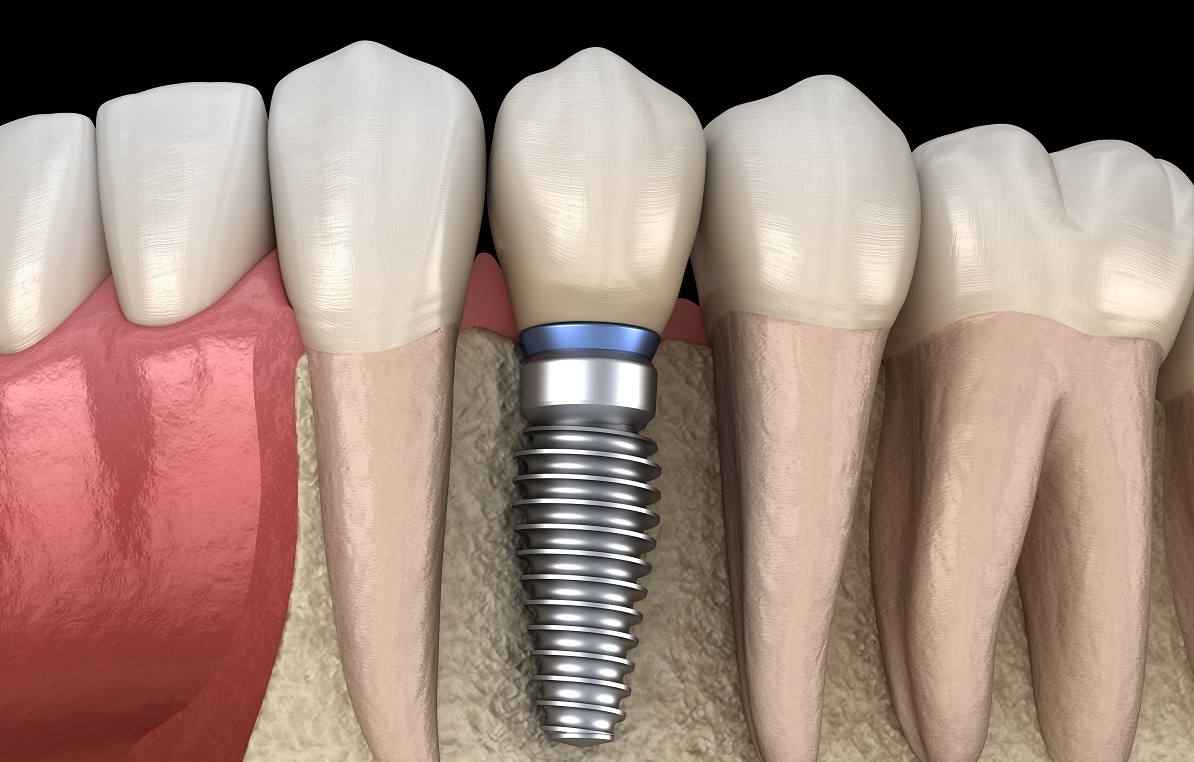 When It’s Time to Extract and Replace a Tooth | Fort Worth, TX