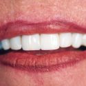 dental implant picture, dental implants benefits