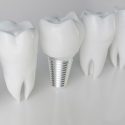 financing dental implants with bad credit