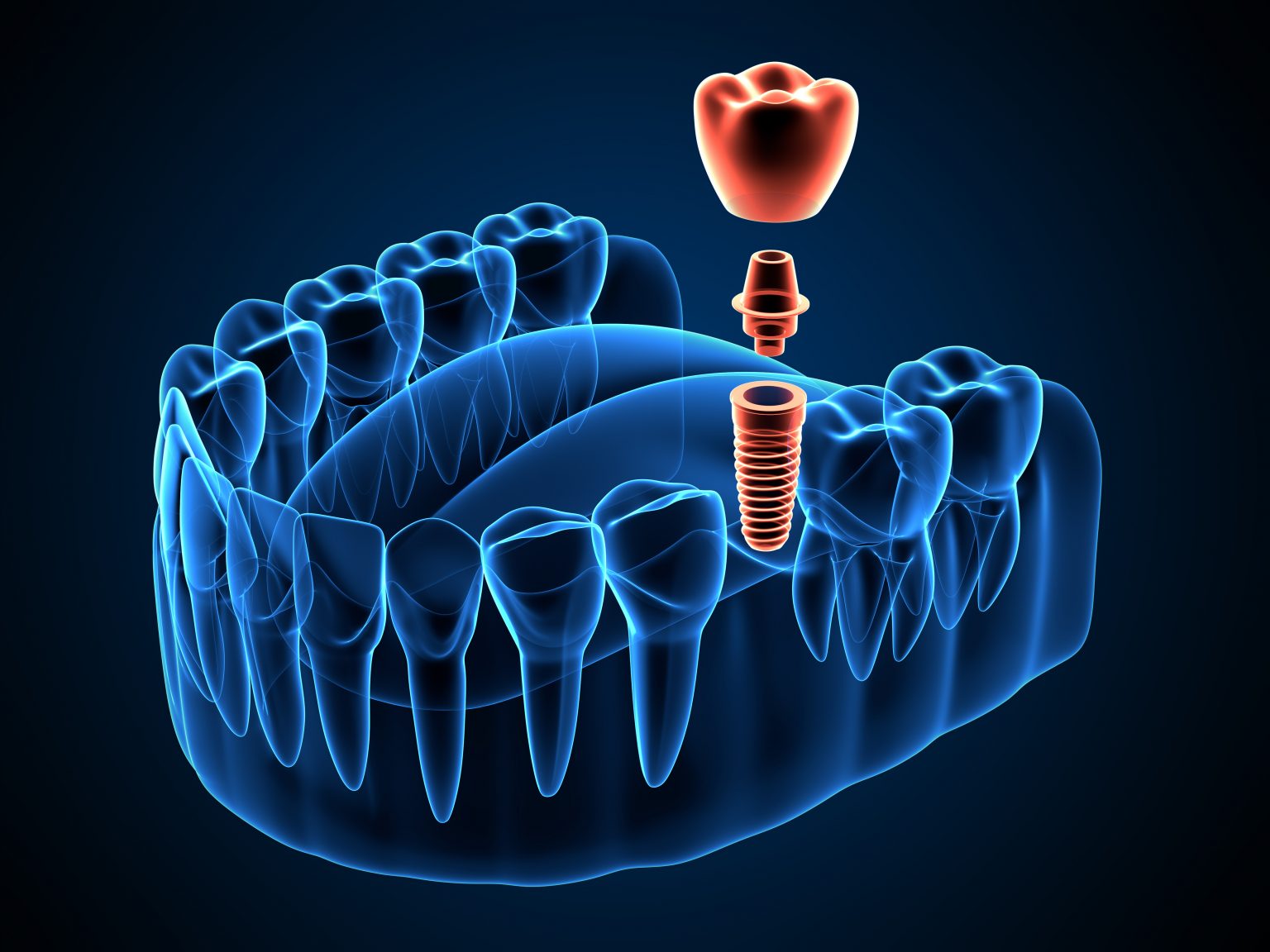 Fort Worth Dentist Explains How We Plan Your Implant Placement Fort