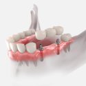 dental implant bridge, dental implants vs bridges