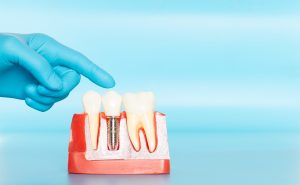 Plastic samples of dental implants compare with natural teeth for patients acknowledged the differences Of both types of teeth. To make decisions before beginning dental implant treatment.