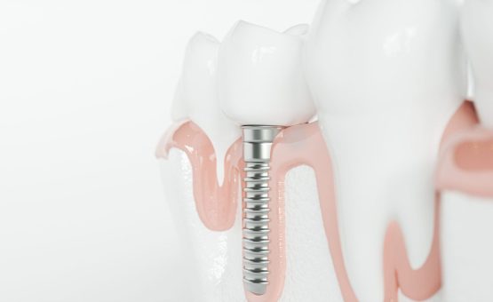 mini dental implants, mini implants