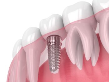 3d render of jaw with dental implant isolated over white background