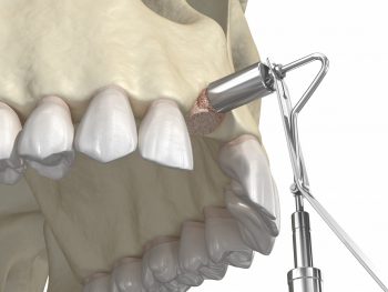 Bone grafts, dental implants