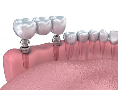 cheap dental implants dallas tx