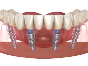 all on 4, dental implants all on 4