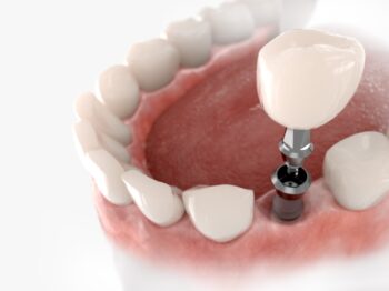 dental implant and crown example