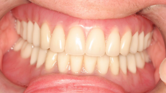 same day dental implant denture same day dental implant denture photo
