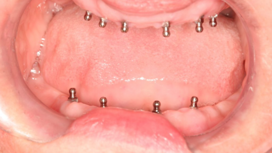 before3 same day dental implants denture before