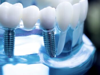 how many dental implants do i need