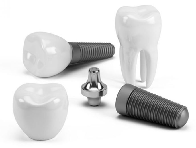 Complete Guide to Dental Implant Parts: Post, Abutment, & Crown | What ...