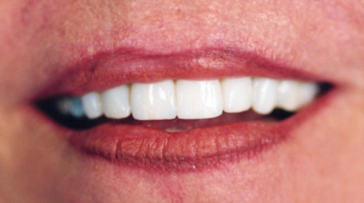 full mouth dental implants fort worth tx